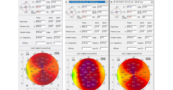 CRSTG Europe Edition High Astigmatism And Amblyopia