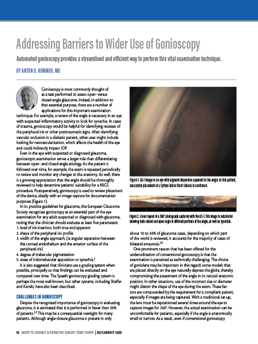 Addressing Barriers to Wider Use of Gonioscopy