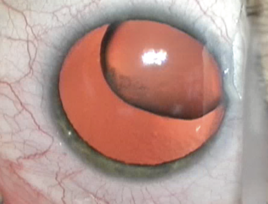 oil droplet cataract