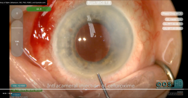 Intraoperative findings: the focus of bleeding from ruptured site of